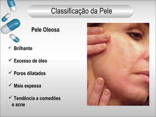 Pele Oleosa
 Brilhante
 Excesso de óleo
 Poros dilatados
 Mais espessa
 Tendência a comedões
e acne
Classificação da Pele
 