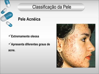 Pele Acnéica
Extremamente oleosa
Apresenta diferentes graus de
acne.
Classificação da Pele
 