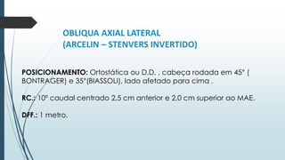 OBLIQUA AXIAL LATERAL
(ARCELIN – STENVERS INVERTIDO)
POSICIONAMENTO: Ortostática ou D.D. , cabeça rodada em 45° (
BONTRAGER) e 35°(BIASSOLI), lado afetado para cima .
RC.: 10º caudal centrado 2,5 cm anterior e 2,0 cm superior ao MAE.
DFF.: 1 metro.
 
