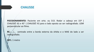 CHAUSSE
POCISIONAMENTO: Paciente em orto. ou D.D. Rodar a cabeça em 15º (
CHAUSSÉ III) e 45° ( CHAUSSÉ IV) para o lado oposto ao ser radiografado. LOM
perpendicular ao filme.
RC.: _|_ centrado entre a borda externa da órbita e o MAE do lado a ser
radiografado.
DFF.: 1 metro
 