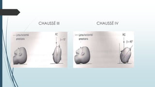CHAUSSÉ III CHAUSSÉ IV
 