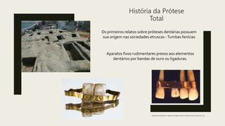 História da Prótese
Total
Os primeiros relatos sobre próteses dentárias possuem
sua origem nas sociedades etruscas -Tumbas fenícias
Aparatos fixos rudimentares presos aos elementos
dentários por bandas de ouro ou ligaduras.
http://www.swissedent.co.uk/denture-blog/the-history-of-dentures-from-700-bce-to-2015
 