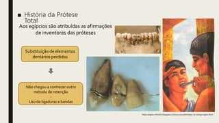 ■ História da Prótese
Total
https://egito-nifertiti.blogspot.com/2012/01/dentistas-no-antigo-egito.html
Aos egípcios são atribuídas as afirmações
de inventores das próteses
Substituição de elementos
dentários perdidos
Não chegou a conhecer outro
método de retenção
-
Uso de ligaduras e bandas
 
