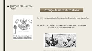 ■ História da Prótese
Total
No ano de 1728, Fauchard retrata em seu livro a prótese completa e a
construção de obturadores palatinos.
http://bvsms.saude.gov.br/bvs/publicacoes/inca/Proteses_obturadores_Sonia_Perez.pdf
Em 1692 Nuck, dentadura inferior completa de um único bloco de marfim.
Avanço de novas tentativas
 