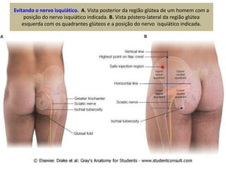 Evitando o nervo isquiático. A. Vista posterior da região glútea de um homem com a
posição do nervo isquiático indicada. B...
