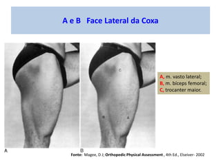 A e B Face Lateral da Coxa
A, m. vasto lateral;
B, m. bíceps femoral;
C, trocanter maior.
Fonte: Magee, D J; Orthopedic Ph...