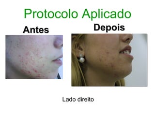 Protocolo Aplicado
Antes              Depois




        Lado direito
 