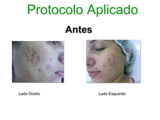 Protocolo Aplicado
               Antes




Lado Direito           Lado Esquerdo
 