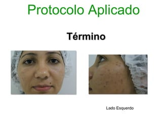 Protocolo Aplicado
      Término




                Lado Esquerdo
 