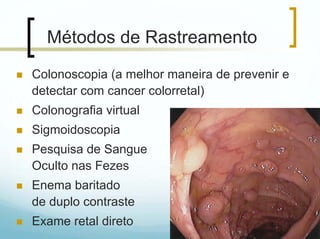 Métodos de Rastreamento
Colonoscopia (a melhor maneira de prevenir e
detectar com cancer colorretal)
Colonografia virtual
Sigmoidoscopia
Pesquisa de Sangue
Oculto nas Fezes
Enema baritado
de duplo contraste
Exame retal direto                             10
 