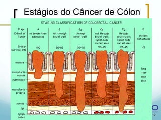 Estágios do Câncer de Cólon




                              12
 