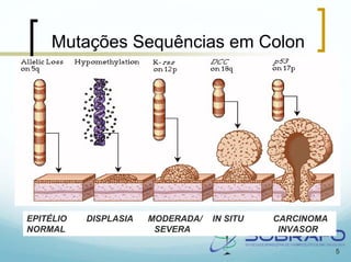 Mutações Sequências em Colon




EPITÉLIO   DISPLASIA   MODERADA/   IN SITU   CARCINOMA
NORMAL                  SEVERA                INVASOR

                                                         5
 