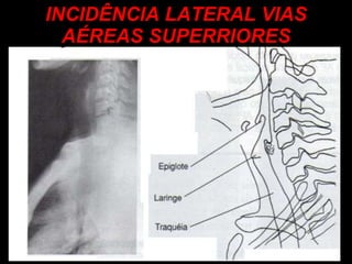 INCIDÊNCIA LATERAL VIAS AÉREAS SUPERRIORES 