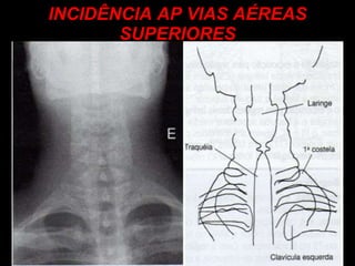INCIDÊNCIA AP VIAS AÉREAS SUPERIORES 