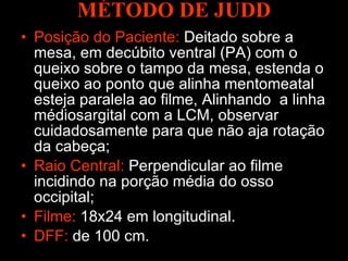 MÉTODO DE JUDD Posição do Paciente:   Deitado sobre a mesa, em decúbito ventral (PA) com o queixo sobre o tampo da mesa, estenda o queixo ao ponto que alinha mentomeatal esteja paralela ao filme,   Alinhando  a linha médiosargital com a LCM, observar cuidadosamente para que não aja rotação da cabeça; Raio Central:   Perpendicular ao filme incidindo na porção média do osso occipital; Filme:  18x24 em longitudinal. DFF:   de 100 cm.   