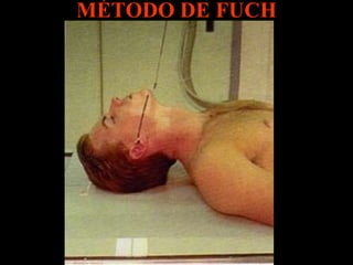 MÉTODO DE FUCH 