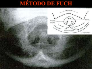 MÉTODO DE FUCH 