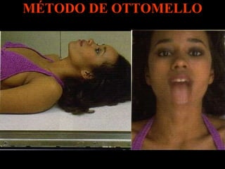 MÉTODO DE OTTOMELLO 