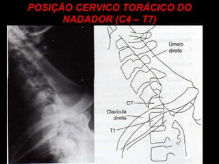 POSIÇÃO CERVICO TORÁCICO DO NADADOR (C4 – T7) 