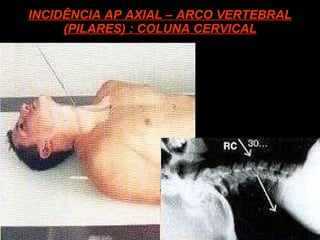 INCIDÊNCIA AP AXIAL – ARCO VERTEBRAL (PILARES) : COLUNA CERVICAL 