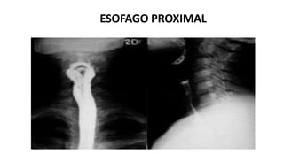 ESOFAGO PROXIMAL
 