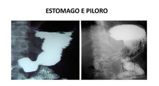 ESTOMAGO E PILORO
 