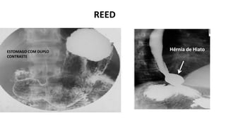 REED
Hérnia de Hiato
ESTOMAGO COM DUPLO
CONTRASTE
 