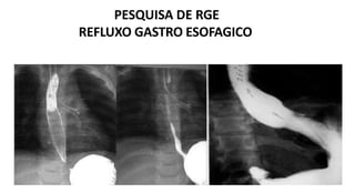PESQUISA DE RGE
REFLUXO GASTRO ESOFAGICO
 