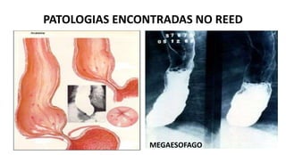 PATOLOGIAS ENCONTRADAS NO REED
MEGAESOFAGO
 