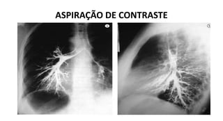 ASPIRAÇÃO DE CONTRASTE
 