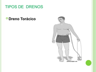 TIPOS DE DRENOS
 Dreno Torácico
 