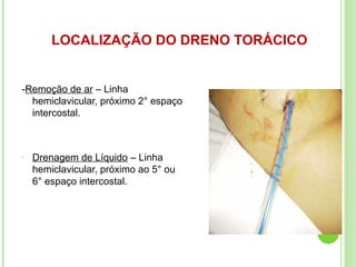LOCALIZAÇÃO DO DRENO TORÁCICO
-Remoção de ar – Linha
hemiclavicular, próximo 2° espaço
intercostal.
- Drenagem de Líquido – Linha
hemiclavicular, próximo ao 5° ou
6° espaço intercostal.
 