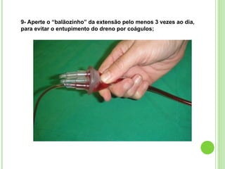 9- Aperte o “balãozinho” da extensão pelo menos 3 vezes ao dia,
para evitar o entupimento do dreno por coágulos;
 