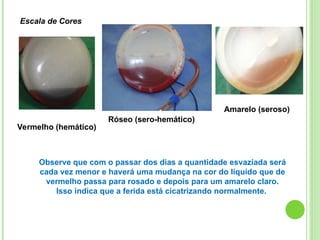 Escala de Cores
Vermelho (hemático)
Róseo (sero-hemático)
Amarelo (seroso)
Observe que com o passar dos dias a quantidade esvaziada será
cada vez menor e haverá uma mudança na cor do líquido que de
vermelho passa para rosado e depois para um amarelo claro.
Isso indica que a ferida está cicatrizando normalmente.
 