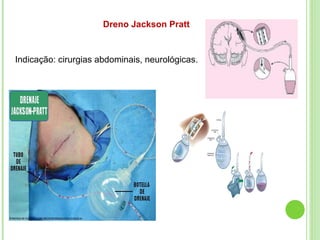 Dreno Jackson Pratt
Indicação: cirurgias abdominais, neurológicas.
 