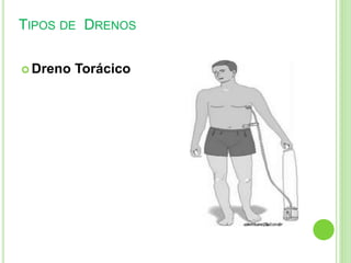 TIPOS DE DRENOS
 Dreno Torácico
 