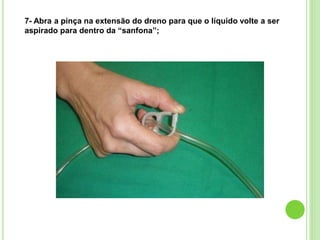 7- Abra a pinça na extensão do dreno para que o líquido volte a ser
aspirado para dentro da “sanfona”;
 