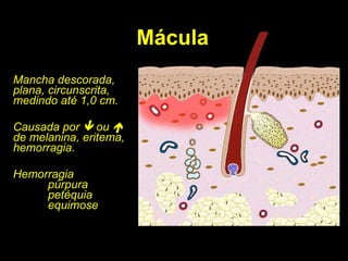 Mácula Mancha descorada, plana, circunscrita, medindo até 1,0 cm. Causada por    ou    de melanina, eritema, hemorragia. Hemorragia púrpura petéquia equimose 