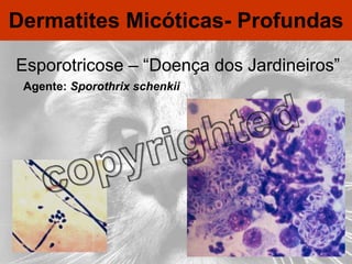 Dermatites Micóticas- Profundas Esporotricose – “Doença dos Jardineiros” Agente:  Sporothrix schenkii 