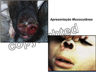 Leishmaniose Apresentação Mucocutânea 