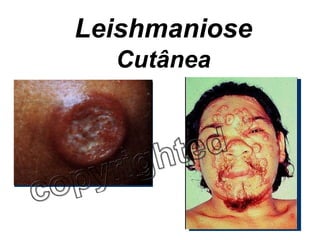 Leishmaniose Cutânea 