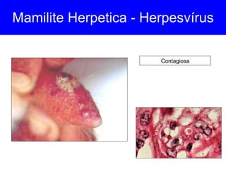 Mamilite Herpetica - Herpesvírus Contagiosa 
