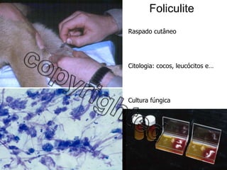 Foliculite Raspado cutâneo Citologia: cocos, leucócitos e… Cultura fúngica 