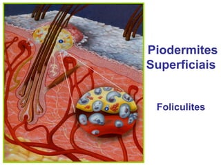 Piodermites Superficiais Foliculites 