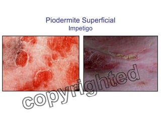 Piodermite Superficial Impetigo 