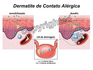 Dermatite de Contato Alérgica sensibilização desafio LN de drenagem Ln = Linfócito Naive Lm = Linfócito de Memória 