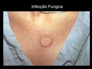 Infecção Fungica 