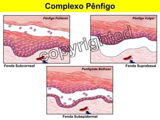 Complexo Pênfigo Fenda Subcorneal Fenda Suprabasal Fenda Subepidermal Pênfigo Foliáceo Pênfigo Vulgar Penfigóide Bolhoso 