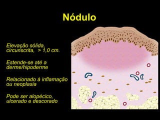 Nódulo Elevação sólida, circunscrita,  > 1,0 cm. Estende-se até a derme/hipoderme Relacionado à inflamação ou neoplasia Pode ser alopécico, ulcerado e descorado 