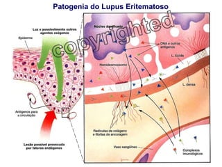 Patogenia do Lupus Eritematoso 